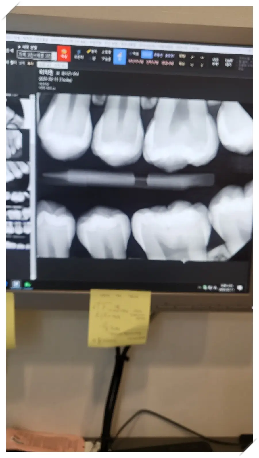 충치-x레이-사진