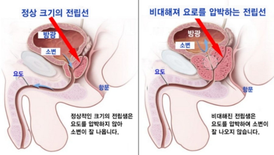 정상 크기의 전립선 위치와 형태와 비대해져서 요도를 압박하고 있는 전립선의 형태와 위치를 비교하고 있는 해부학 이미지 사진