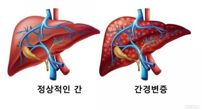간경화 초기증상 치료법 간이 나쁘면 나타나는 증상 15가지