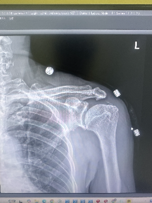 병원 모니터에서 확인되는 석회성 건염 환자의 어깨 X-ray 영상