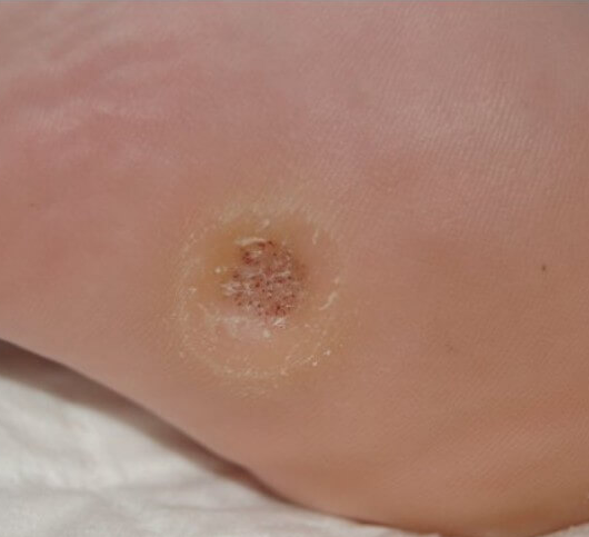 티눈-없애는-방법