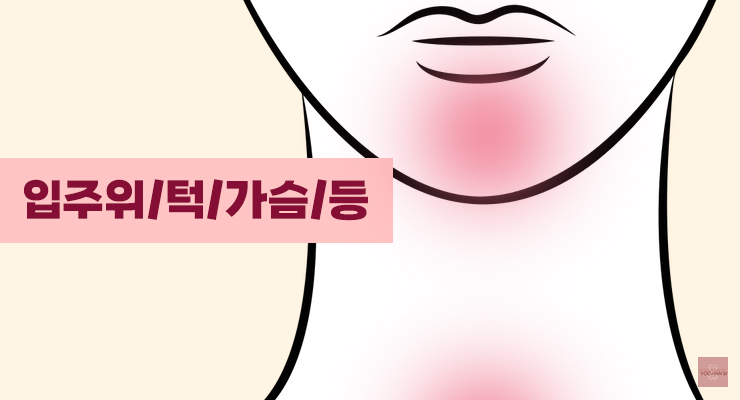 여드름 부위별 원인 입 주위 턱 가슴