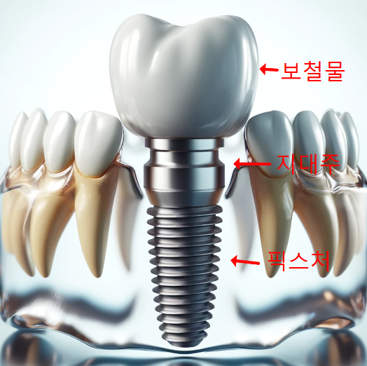 일반 임플란트