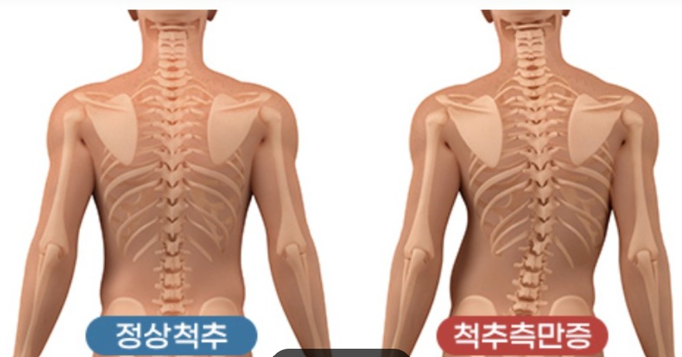 정상 척추와 척추 측만증
