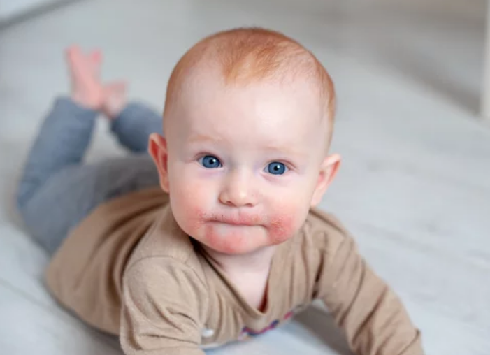 엄마 장내 미생물과 소아 아토피 피부염 관계 밝혀져