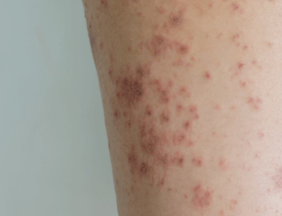 곰팡이 완벽제거방법&amp;#44; 겨울철 곰팡이 완벽제거방법&amp;#44;여름철 곰팡이 완벽제거 방법&amp;#44; 곰팡이가 생기는 원인&amp;#44;곰팡이가 생기는 원인 환기부족&amp;#44;곰팡이가 생기는 원인 결로현상&amp;#44;곰팡이가 생기는 원인 습도증가&amp;#44; 곰팡이가 생기는 원인 단열문제&amp;#44;곰팡이가 생기는 원인 습기축적&amp;#44;곰팡이가 생기는 원인 습한날씨&amp;#44;곰팡이로 인해 생기는 질병&amp;#44;호흡기 질환&amp;#44;알레르기 질환&amp;#44; 천식&amp;#44; 폐 질환&amp;#44; 피부 질환&amp;#44; 눈 질환&amp;#44; 면역 악화&amp;#44; 곰팡이 완벽제거 방법 락스&amp;#44; 곰팡이 완벽제거 방법 식초&amp;#44; 곰팡이 완벽제거 방법 곰팡이제거제&amp;#44; 곰팡이 냄새 완벽제거 베이킹소다&amp;#44; 곰팡이 냄새 완벽제거 숯&amp;#44; 곰팡이냄새 완벽제거 레몬&amp;#44; 곰팡이 냄새 완벽제거 라벤더오일&amp;#44; 곰팡이 완벽제거 후 재발방지방법&amp;#44; 정기적 청소&amp;#44; 누수점검&amp;#44; 누수방지&amp;#44; 방수처리