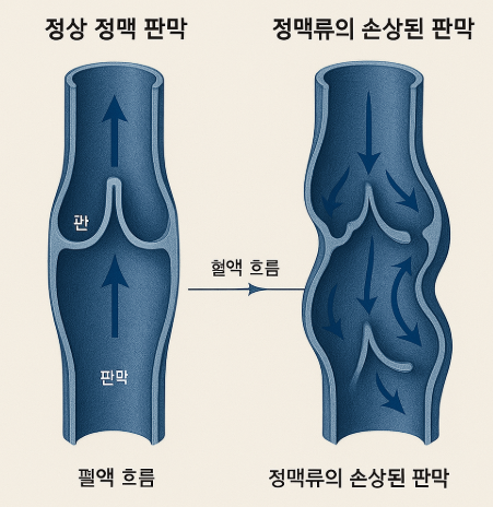 정맥 판막의 정상 상태와 하지정맥류 비교 이미지