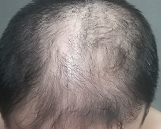 남성 탈모 대부분을 차지하는 유형 중 M자 탈모의 원인과 두타스테리드(아보다트)치료와 부작용 그리고 주의 사항 및 5년 간 실제 복용 후기