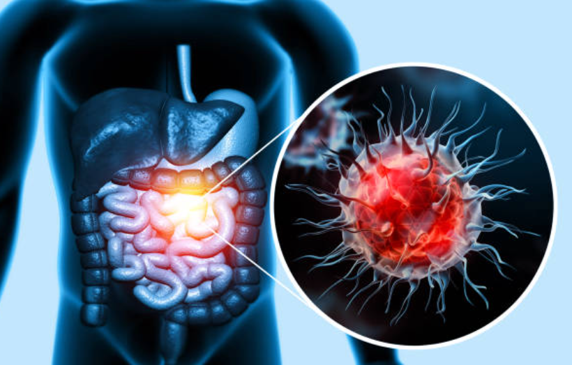 대장암과 관련된 사진2