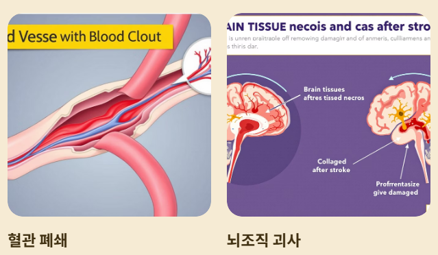 뇌경색이란?