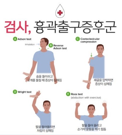 흉곽출구증후군