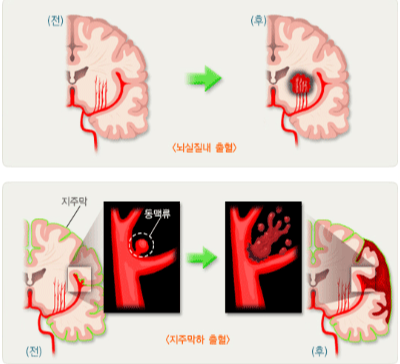 출혈성 뇌졸증 출처 hi.njic.co.kr