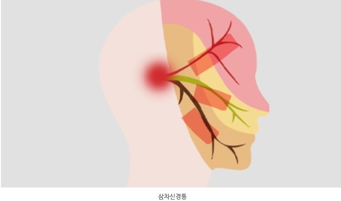 삼차 신경통 약물 치료
