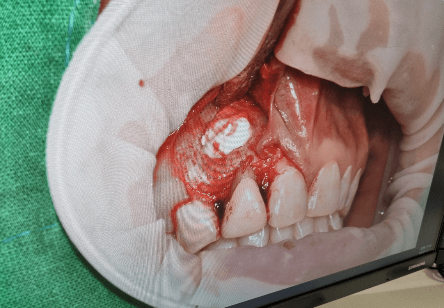 치근단절제술 뼈이식