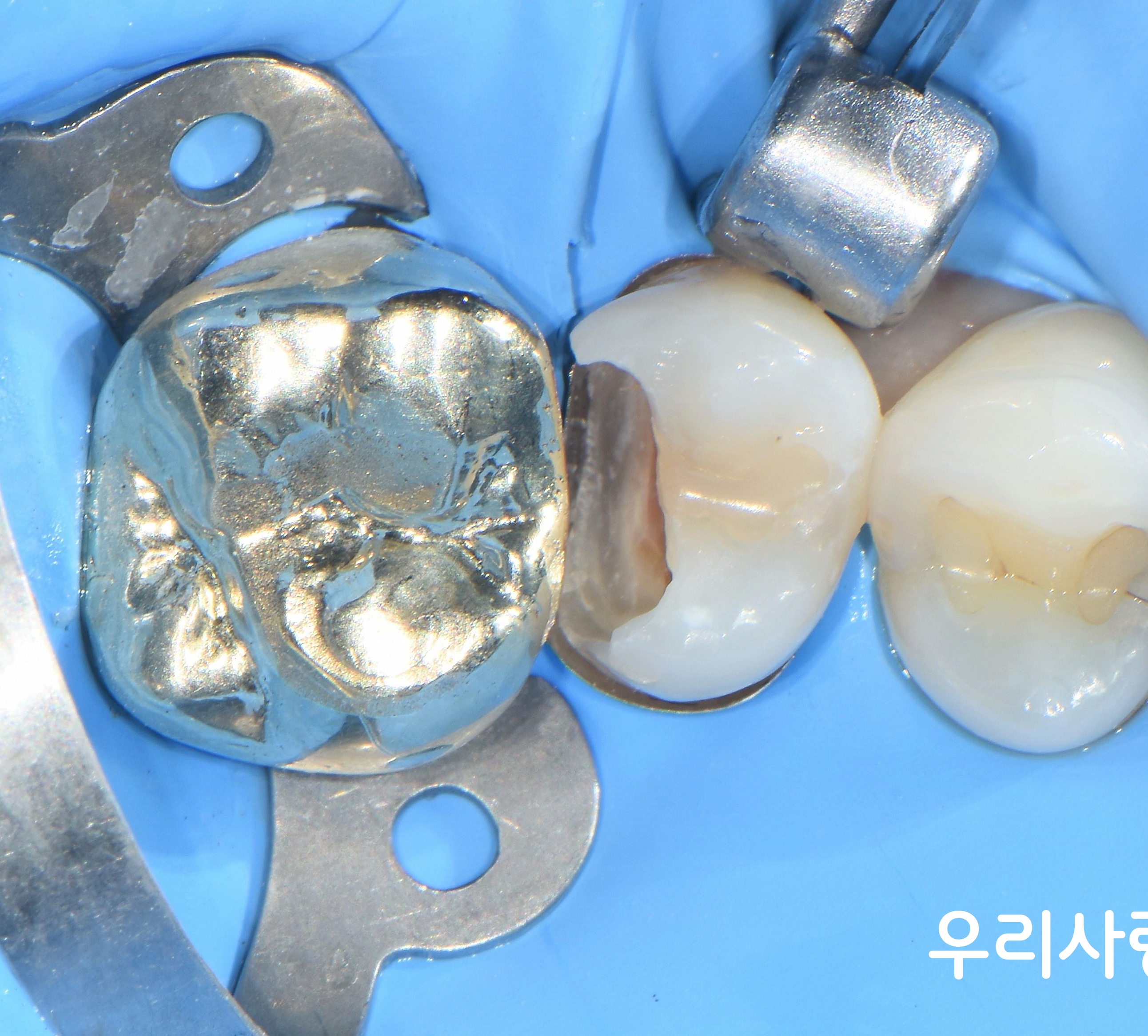 어금니 충치치료를 위해 러버댐을 장착한 모습