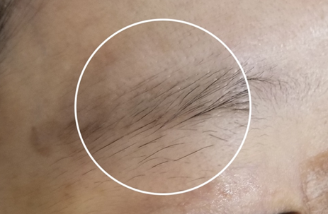 서울 눈썹문신 제거후 관리 제거비용 눈썹문신 제거 후기