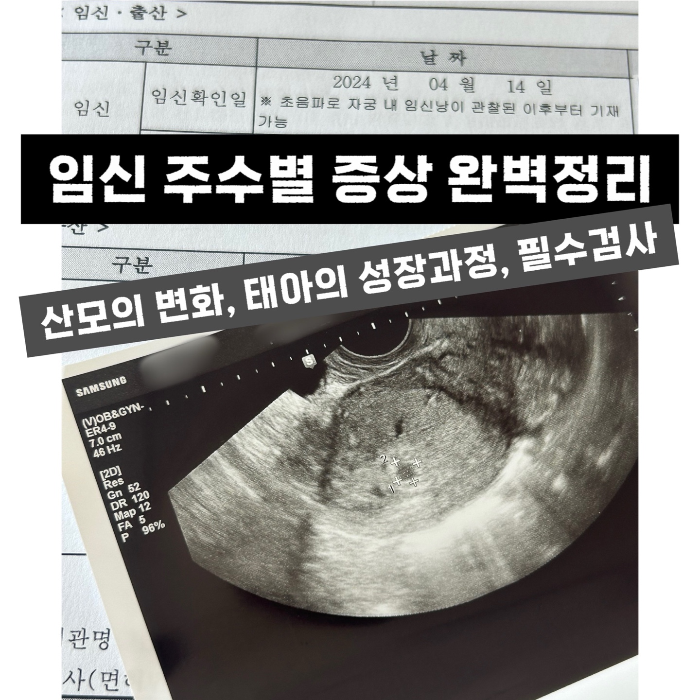 임신 초음파 사진