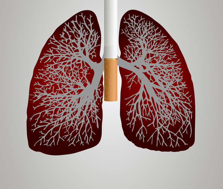 폐암 치료&amp;#44; 지금 알아야 할 15가지 핵심 전략
