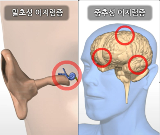 어지럼증을 일으키는 귀질환과 뇌질환 그림