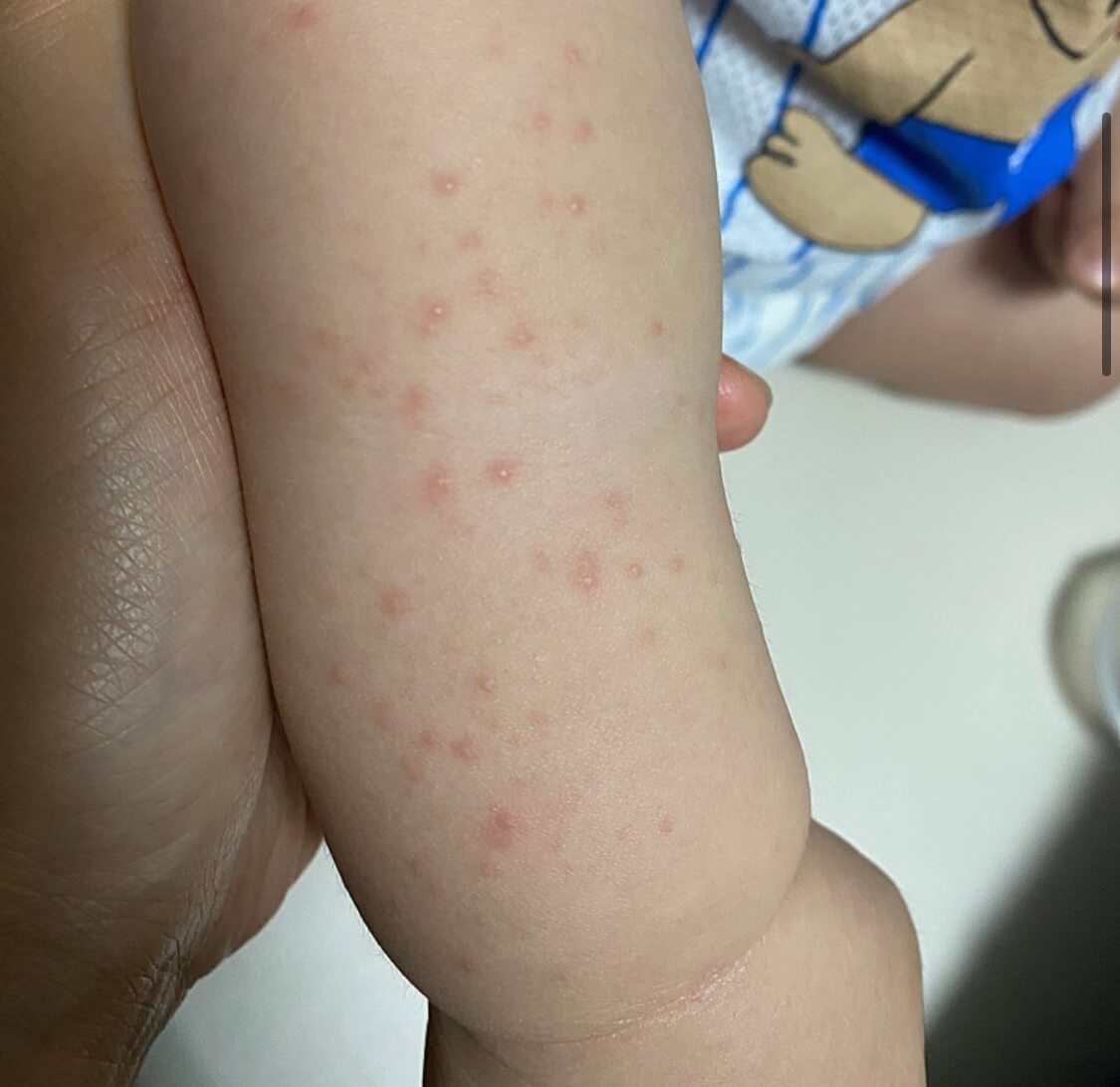 수족구 증상 예방 조치 전염 기간