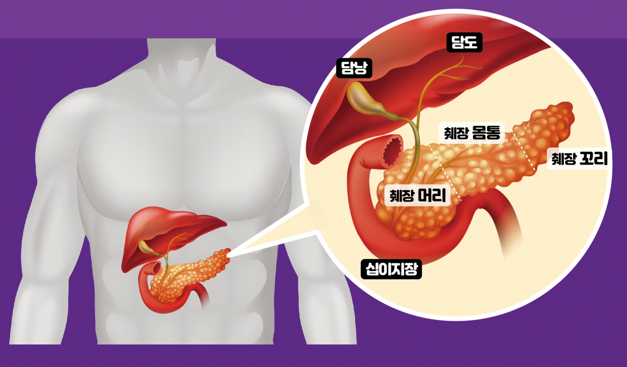 췌장암 초기 증상