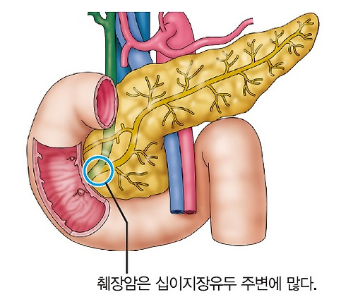 췌장암 초기증상