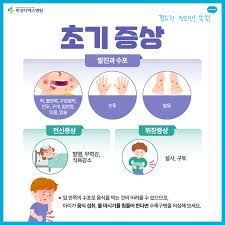 2025년 여름 수족구병 급증이유?