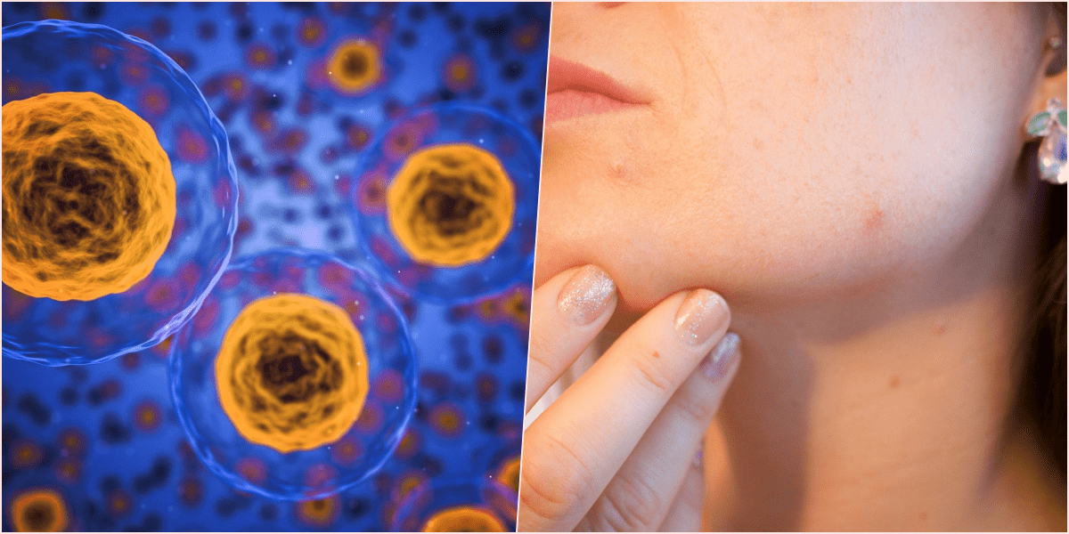 얼굴 대상 포진