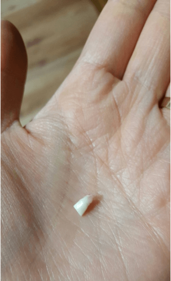 빠진-아랫니를-손바닥에-올려놓은-모습