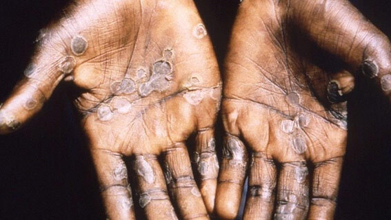 원숭이두창 증상