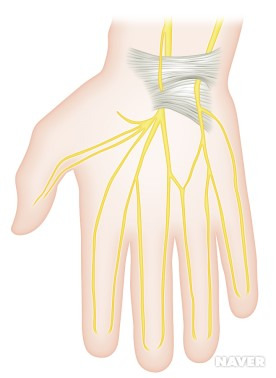 손목터널증후군 증상 원인 치료 방법