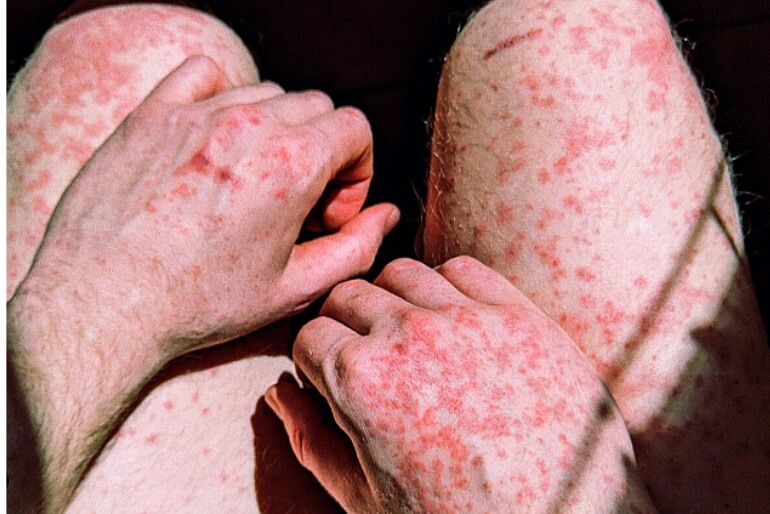 홍역예방접종 성인 홍역 예방접종