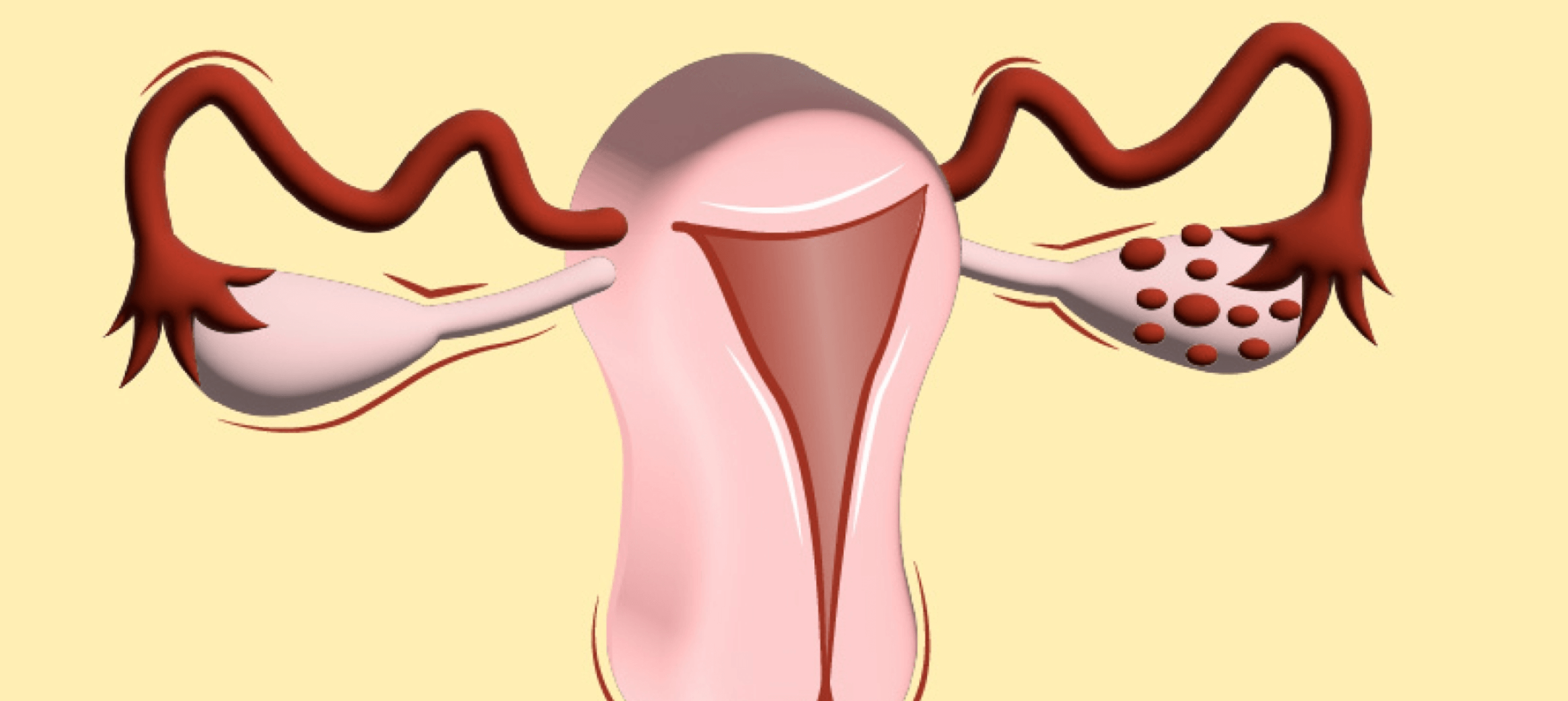 다낭성 난소 증후군 원인