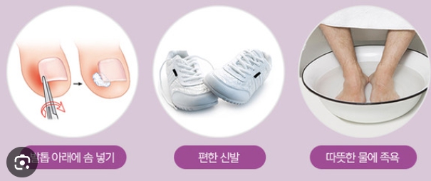 발톱무좀 가이드
