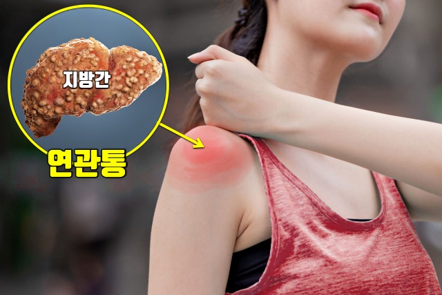 오른쪽 어깨 통증 원인, 간이 안좋을때 나타나는 증상, 간암 간경화 지방간 증상, 건강, 팁줌 매일꿀정보