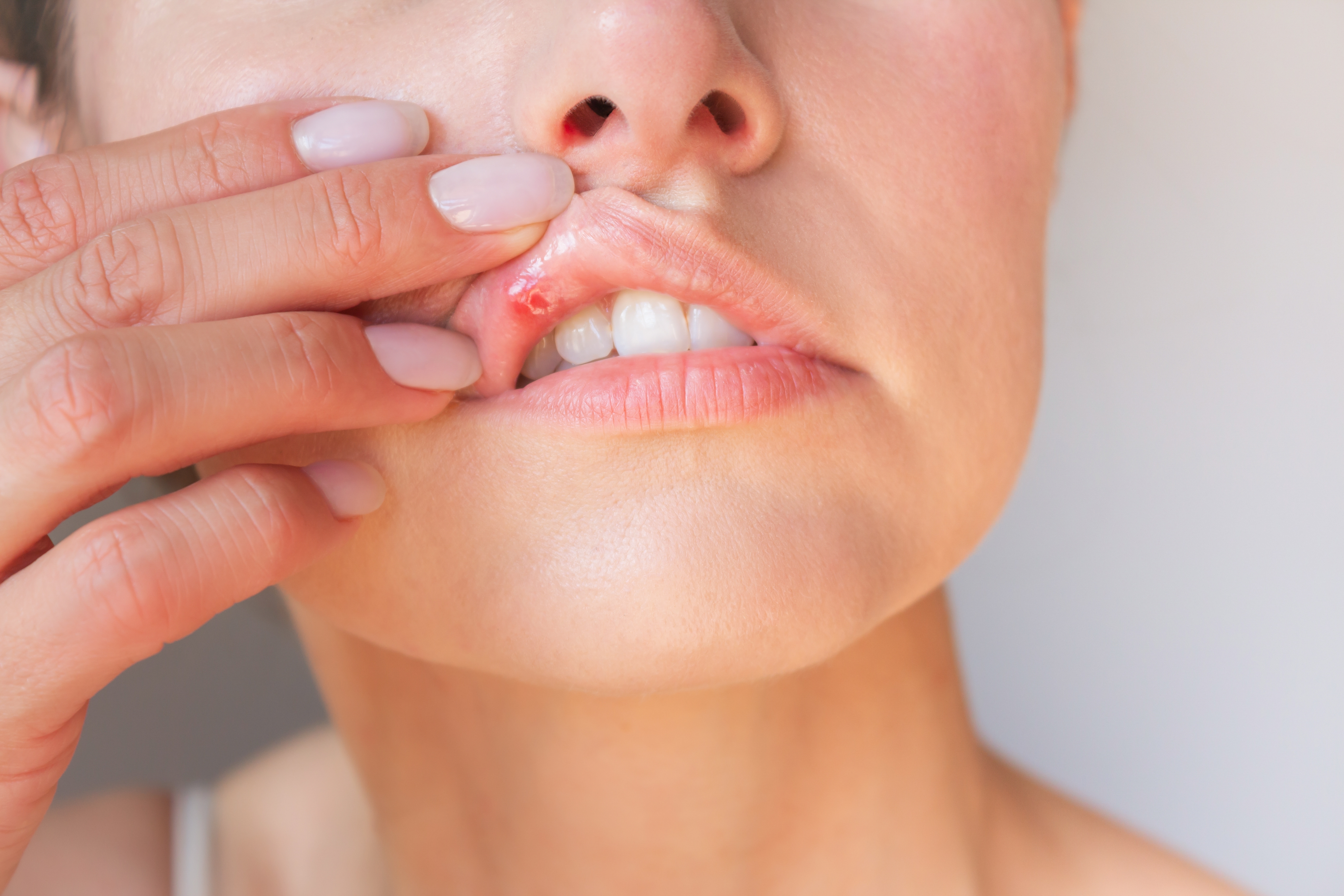 아프타성_구내염_증상_원인_빨리낫는법