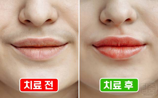 여자 인중 수염 없애는법 제모 없이 여자턱수염