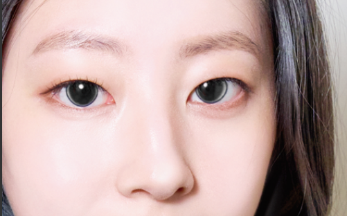 아이링 수술, 눈동자 성형, 아이링 수술 가격, 아이링 수술 부작용, 아이링 수술 후기, 아이링 수술 전후 사진, 아이링 수술 회복 기간, 서클렌즈 대체 성형, 눈동자 확대 수술