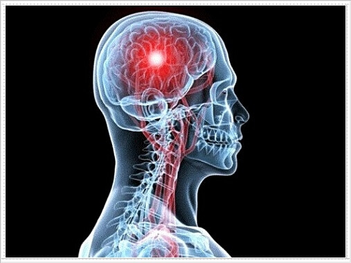 뇌질환 증상 10가지