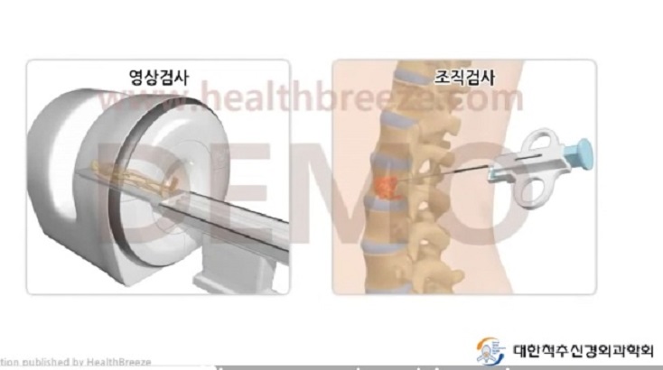척수척추종양-명의-김치헌교수