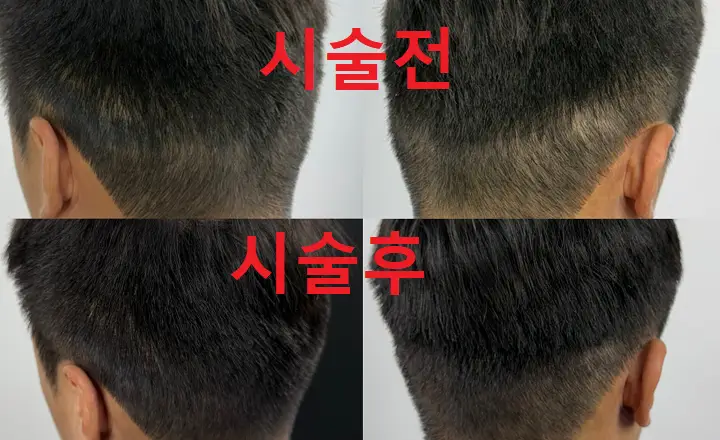 smp 두피문신 비포 애프터