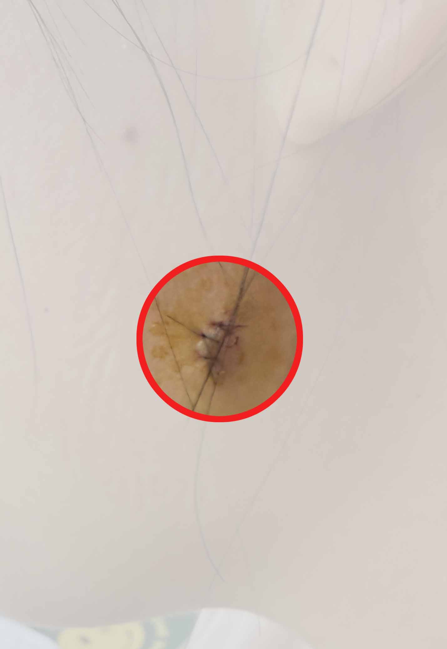 피지낭종제거-수술부위-턱