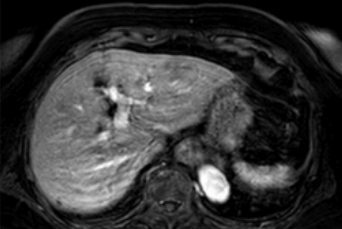 간MRI 간암진단 최고의 방법!
