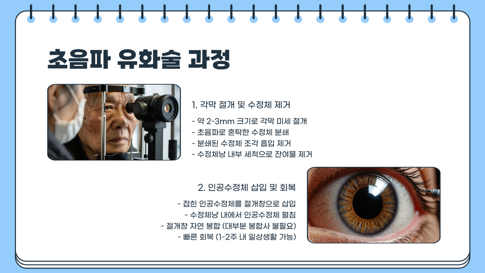 백내장 증상 치료