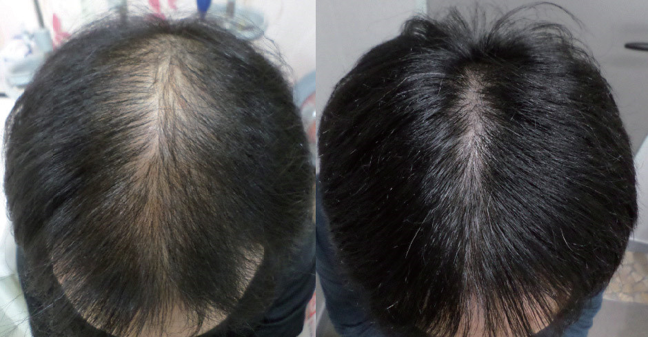 아누카사진 탈모예방