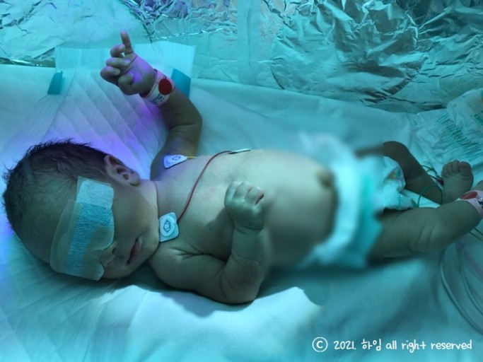 신생아 황달 치료