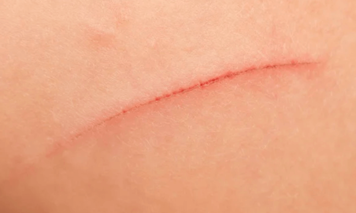 아르기닌 상처 회복