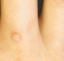 사마귀 원인과 제거방법