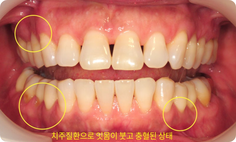 치아 교정