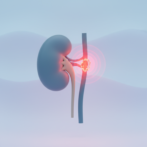 요로결석: 갑작스런 통증의 주범!